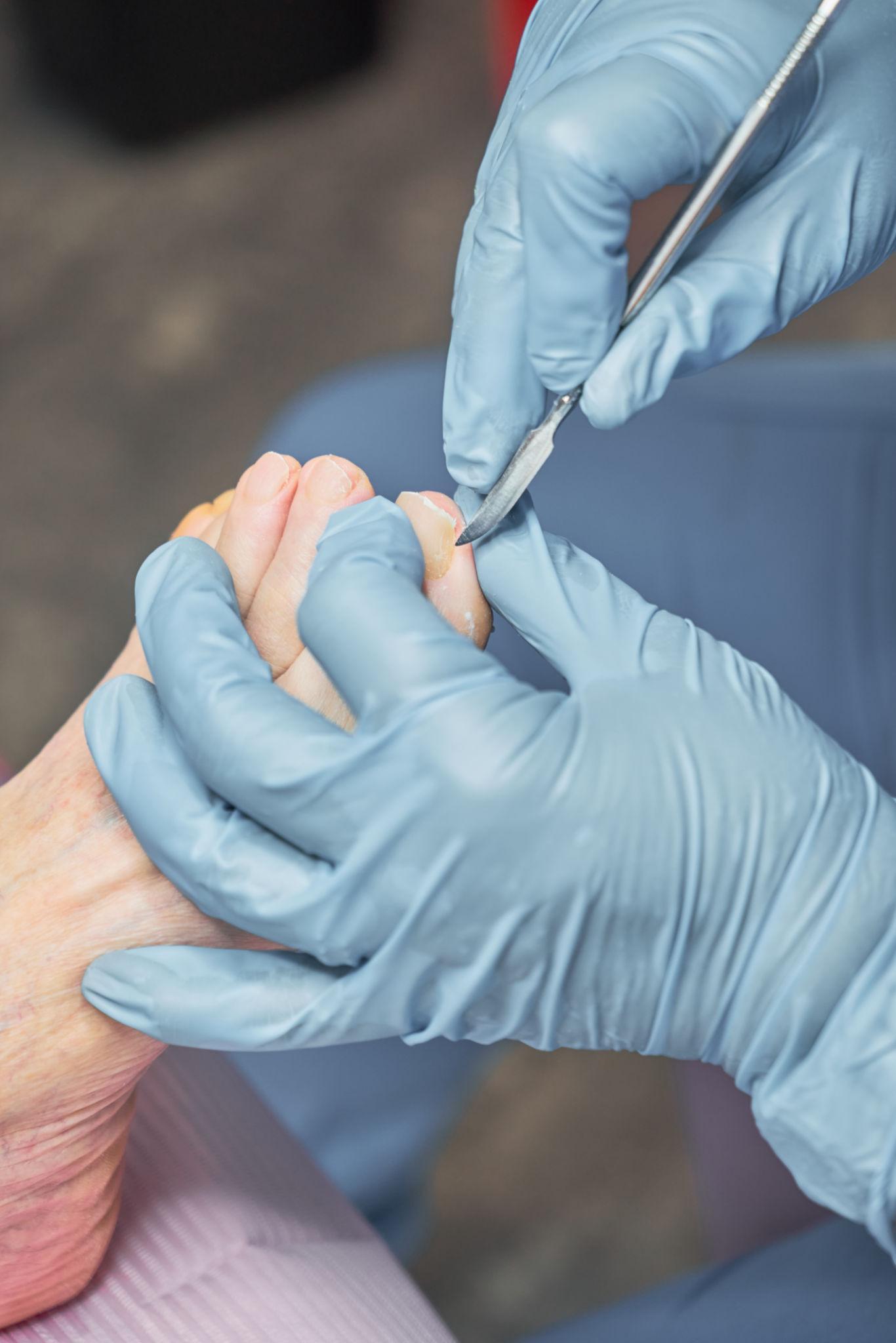 PEDICURA CLINICA | CON ACRÍLICO MEDICADO